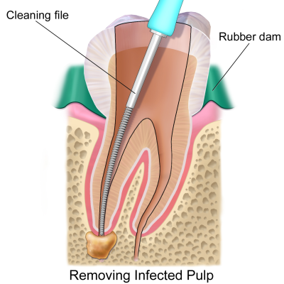 Removing Infected Pulp
